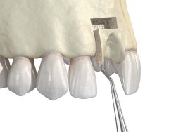 Do You Need a Bone Graft for Dental Implant?