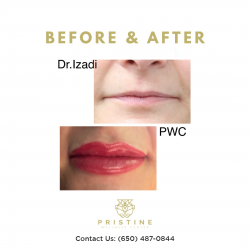 Lip Fillers Treatment San Ramon CA