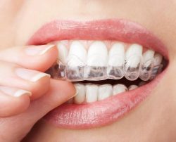 Dental Veneers Treatment Houston