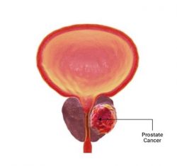 All About Prostate Cancer: Causes, Signs, Diagnosis, and Treatment