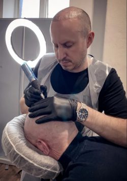 Scalp Micropigmentation