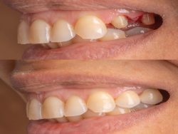 Same Day Dental Crowns Near Me