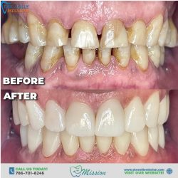 Affordable Teeth Veeners in Miami