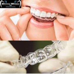 Best Invisible braces treatment in Delhi