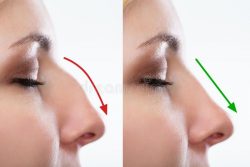 Nose Surgery in Delhi