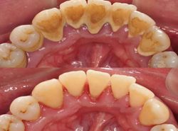 Gum Disease Treatment Specialist | Signs and Symptoms of Gingivitis