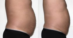 Laser Liposuction Near Me