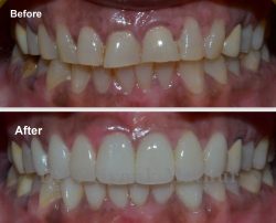 Benefits of Dental Crown Procedure | Dental Crown Near Me