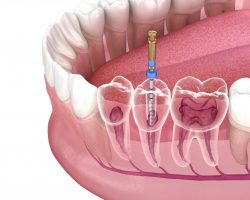 Emergency Root Canal Dentist Near Me