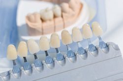 Dental Veneers Near Me | dentistveneershouston