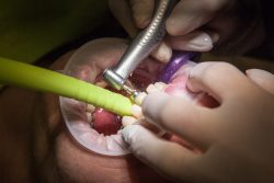 Emergency Root Canal Specialist Near Me | Endodontist Near Me