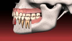 Dental Bridge Cost | Cantilever Bridge Dental