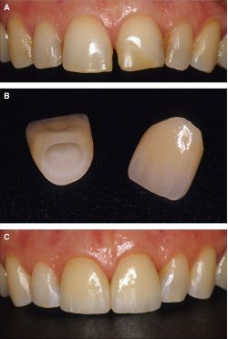 Guide To Biological Width | Supragingival Margin | Equigingival Margin