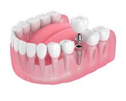 Dental Implants Houston, TX | Life Smiles In Houston