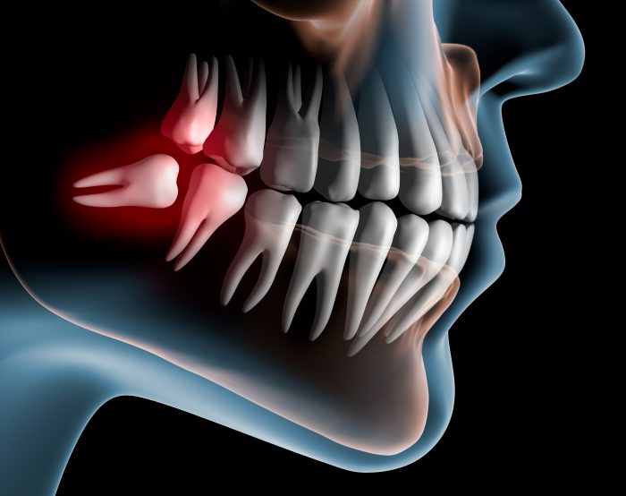 Wisdom Tooth Removal Procedure
