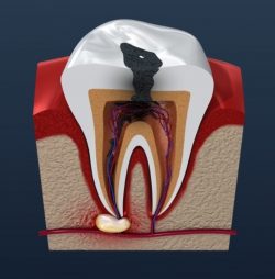 Emergency Root Canal Specialist | Endodontist Near Me