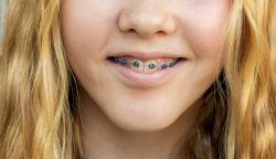 Affordable Braces | Best Dental Braces Near Me