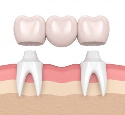  Cantilever Bridge Dental | Maryland Bridge Dental