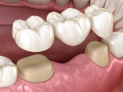  Cantilever Bridge Dental | Maryland Bridge Dental | cantilever bridge dental cost