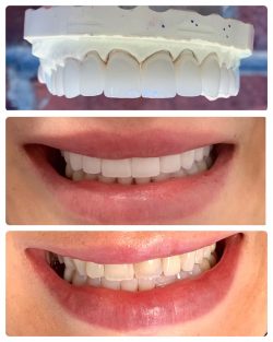 Full Dental Makeover Treatment in Houston,TX | Life Smiles In Houston Texas