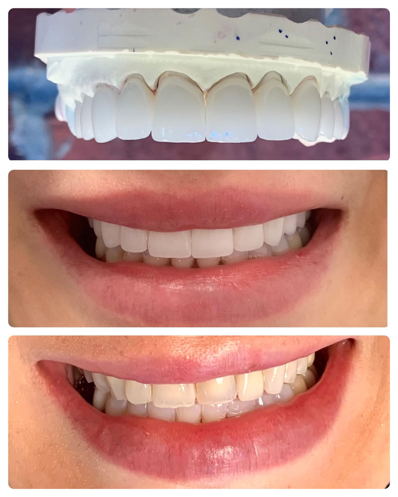 Full Dental Makeover Treatment in Houston,TX | Life Smiles In Houston Texas