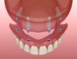 All On 4 Dental Implants Houston TX