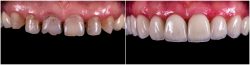 Dental Crowns Houston TX `