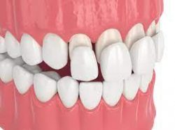 Dental Veneers Near Me | Cosmetic Dentistry Clinic