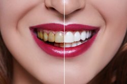 Dental Veneer Before And After