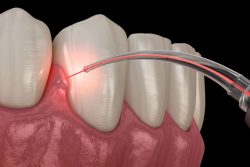 LANAP periodontal surgery Near Me