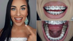 Braces Cost in Miami