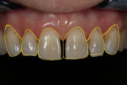 Supragingival Margin | Equigingival Margin