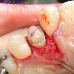 crown lengthening surgery procedure