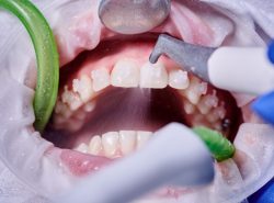 Dental Teeth Cleanings Near Me | Dental Scaling