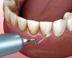 Gingival Recession Surgery in Houston | Laser Gum Regeneration Houston