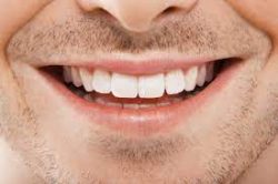 Gum Recession Treatment in Houston | Laser Gum Therapy