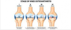 Αρθρίτιδα (Οστεοαρθρίτιδα) Γόνατος Θεραπεία