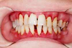 Gum Disease Treatment Specialist in Houston,TX | Periodontal Therapy