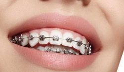 Best Orthodontist In Miami