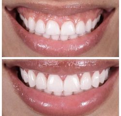 Dental Veneers VS Lumineers Cost