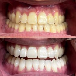 Professional Teeth Whitening