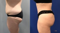 Brazilian Butt Lift (BBL) Surgery Near Me