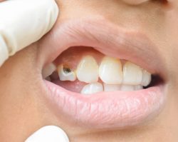 Fix Cavity on Front Tooth | Cavities/tooth decay