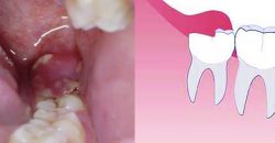 Infected Wisdom Tooth Removal Recovery | Impacted Wisdom Tooth