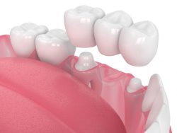 Same Day Dental Crowns Near Me |same day crowns disadvantages