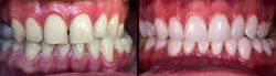 Dental Veneers Services Houston | Porcelain Veneers