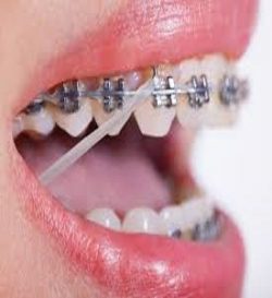 The Process Behind Choosing Braces Band Colors? | Braces Color Wheels