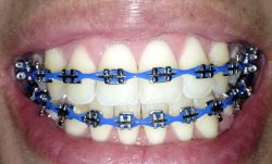 How Do Underbite Braces Work? | Fix Underbites