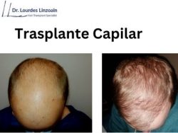 Consulte Por El Mejor Trasplante De Cabello En España