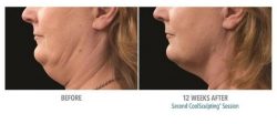 CoolSculpting Before and After Pictures